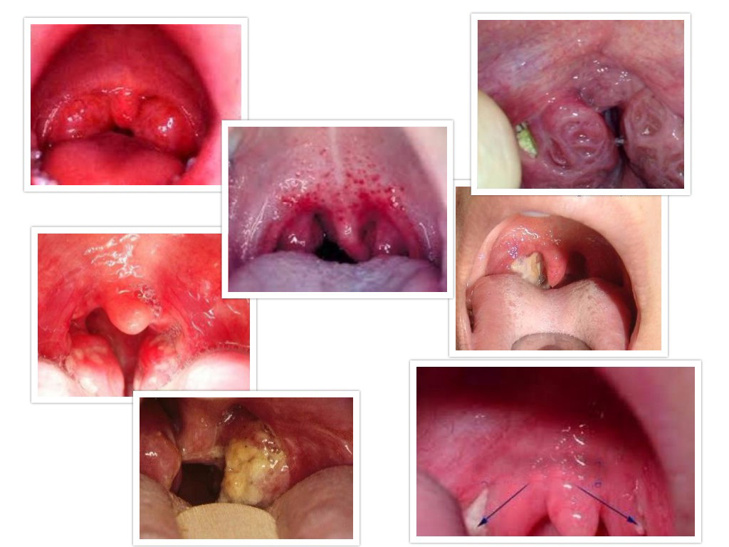 Holes Crypts in Tonsils and Strep Throat Pictures