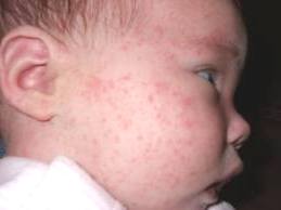 food allergy in infants 2