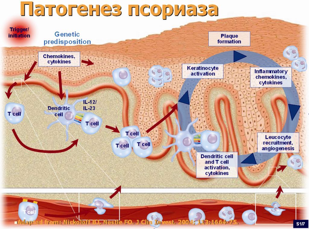 patogenez-psoriaza