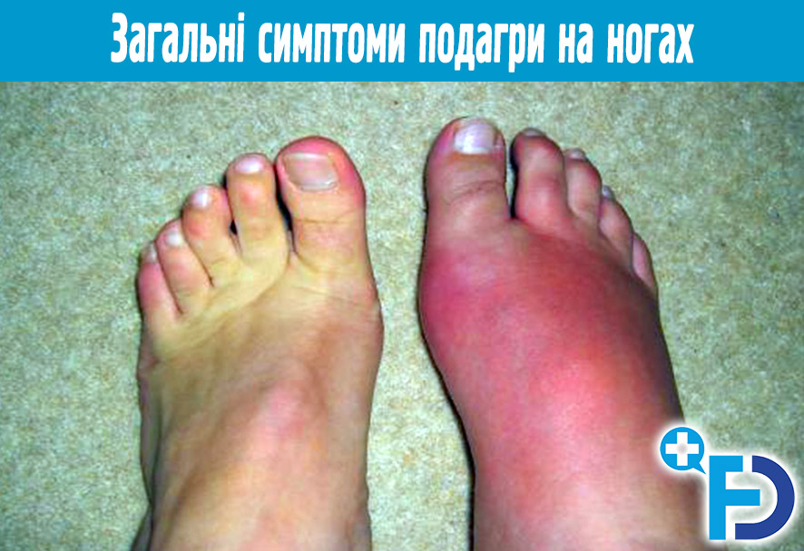 simptomi podagri na nogah