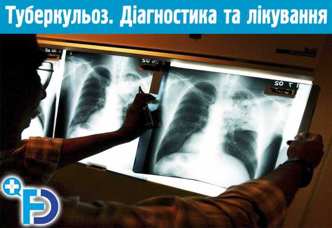 Туберкульоз. Діагностика та лікування туберкульозу