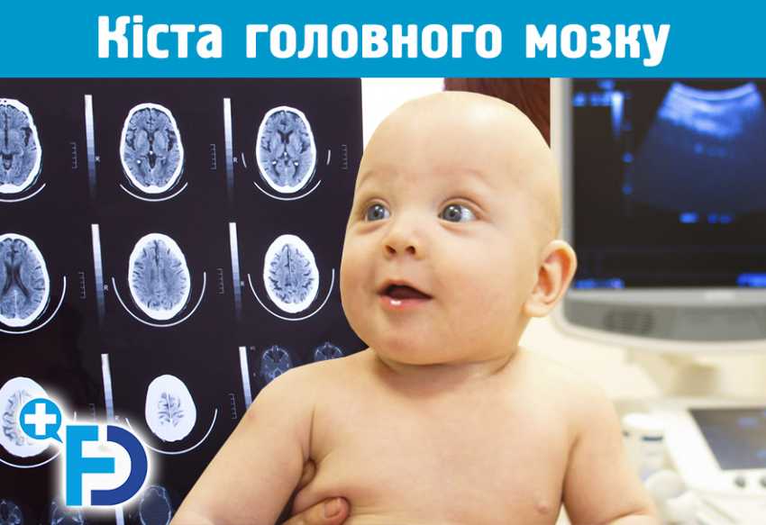 Кіста головного мозку у новонароджених