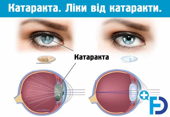 Катаракта. Ліки від катаракти. Народні методи лікування катаракти