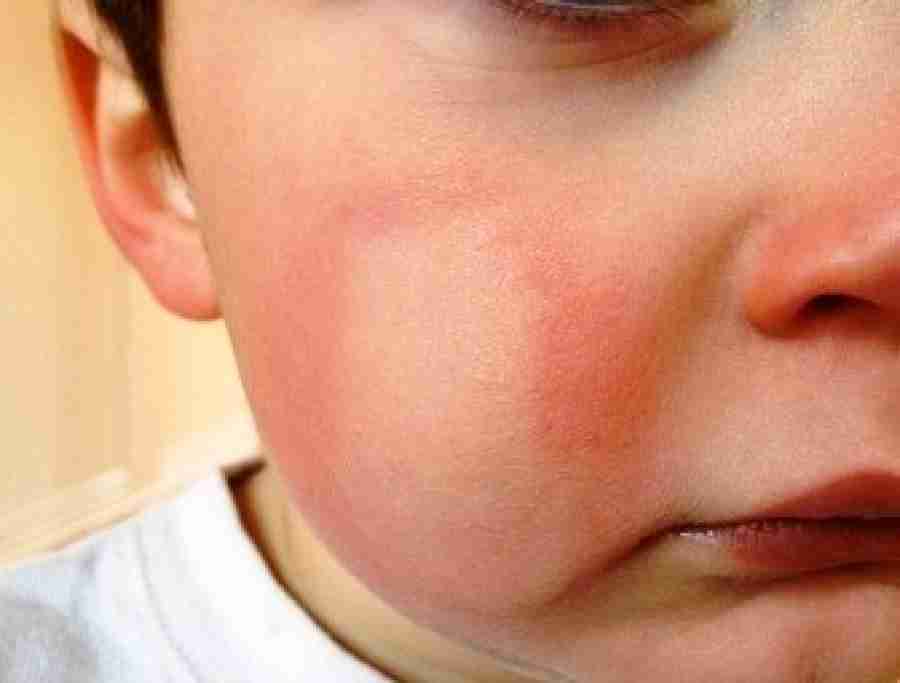 Алергія на холод: симптоми, лікування