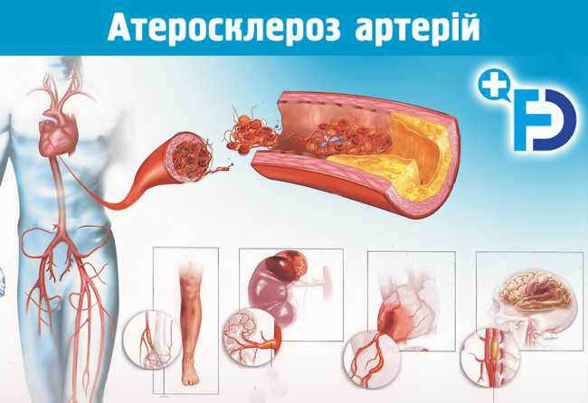 Атеросклероз артерій
