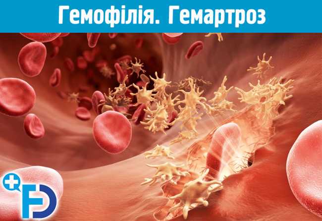 Гемофілія. Гемартроз – найчастіший прояв гемофілії