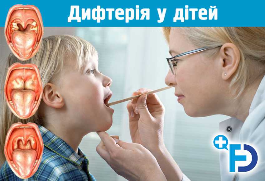 Дифтерія у дітей: симптоми, ознаки, лікування