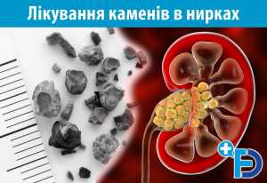 Лікування каменів в нирках спричинених оксалатами