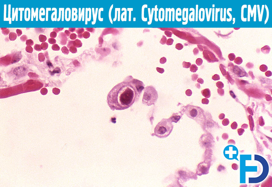 Cytomegalovirus CMV