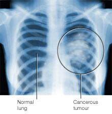 Rak legkih rentgen