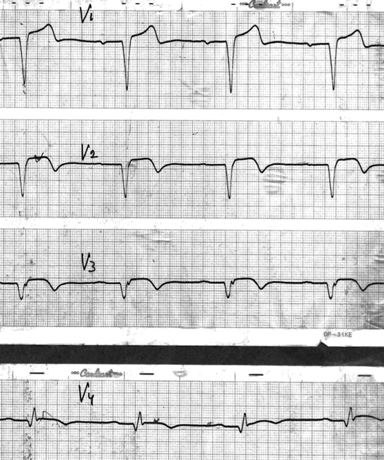 Ris. 3. Pidgostriy Q infarkt miokarda transmuralniy