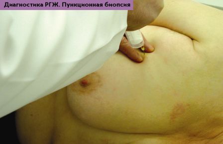 Пункционная биопсия груди