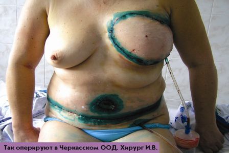 Операция на груди. Рак груди