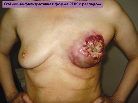 Отёчно-инфильтративная форма рака груди с распадом