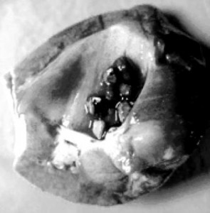 Множинні кальцієвооксалатні камені (0,5 x 0,5 cм) в збиральній системі нирки