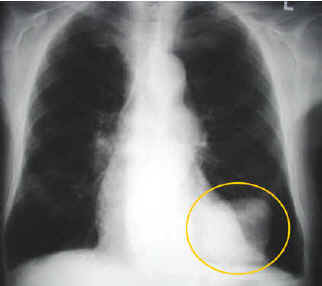 lung cancer1