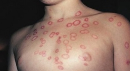 microsporia in children photo