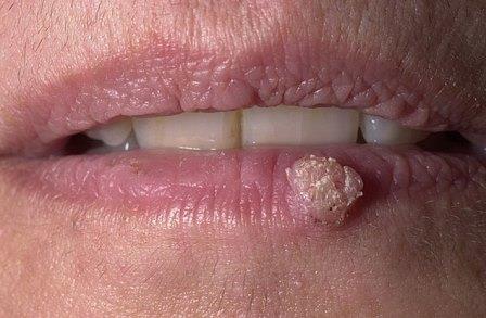 papilloma on the lip