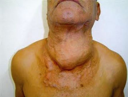 Рак щитовидной железы фото