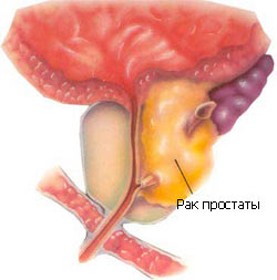 simptomy raka prostaty1