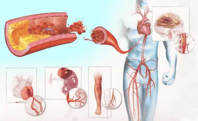 Ишемическая болезнь сердца. ИБС – симптомы, причины и лечение