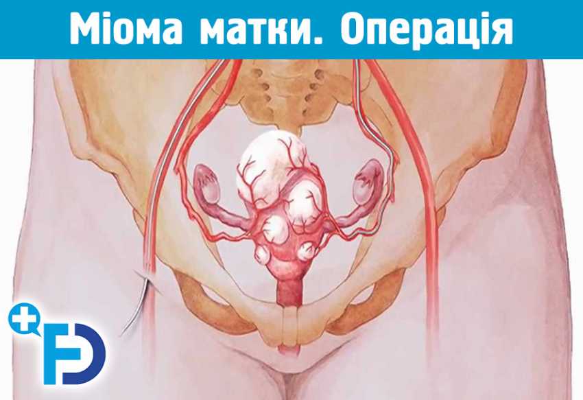 Операція з видалення міоми матки