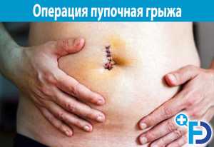 Пупочная грыжа операция