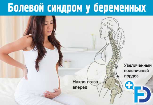 Пояснично-крестцовый болевой синдром у беременных