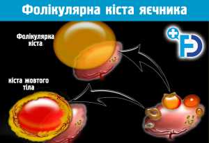 Фолікулярна кіста яєчника