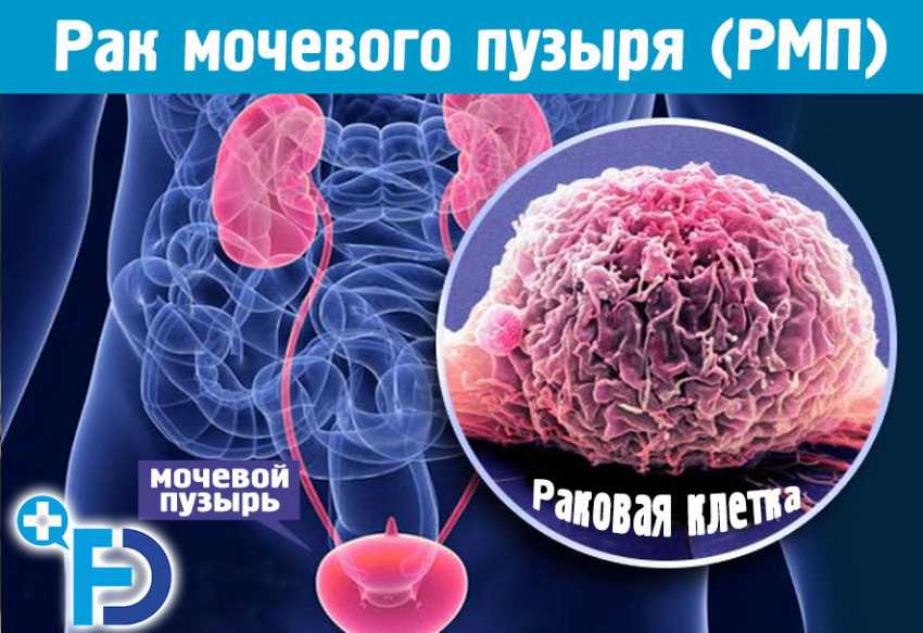 Рак мочевого пузыря (РМП)