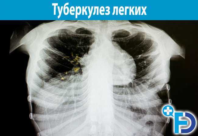 Туберкулез легких: причины возникновения и симптомы