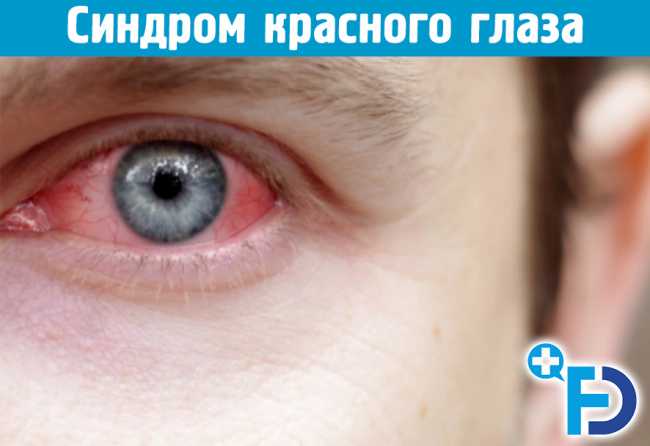Синдром красного глаза. СКГ