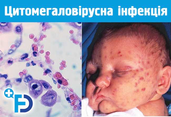 Цитомегаловірусна інфекція у дітей: симптоми, лікування