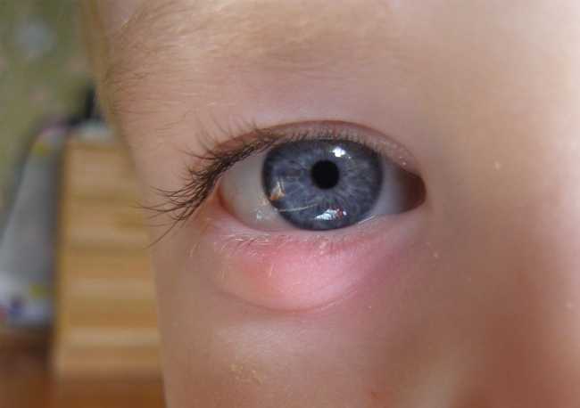 Ячмінь на оці у дитини: причини, лікування