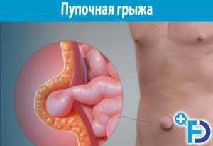 Диагноза пупочная грыжа. Осложнение заболевания