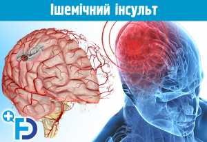 Особливості церебрального кровозабезпечення. Ішемічний інсульт