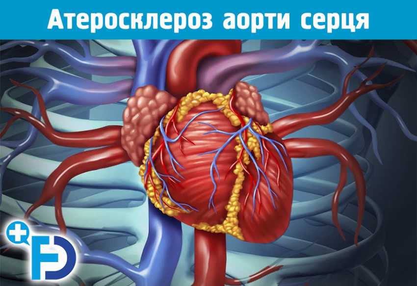 Атеросклероз аорти серця та його лікування