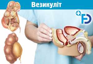 Везикуліт: симптоми, лікування, антибіотики