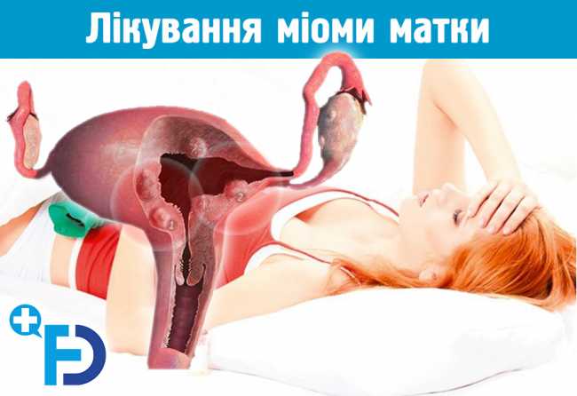 Народне лікування міоми матки