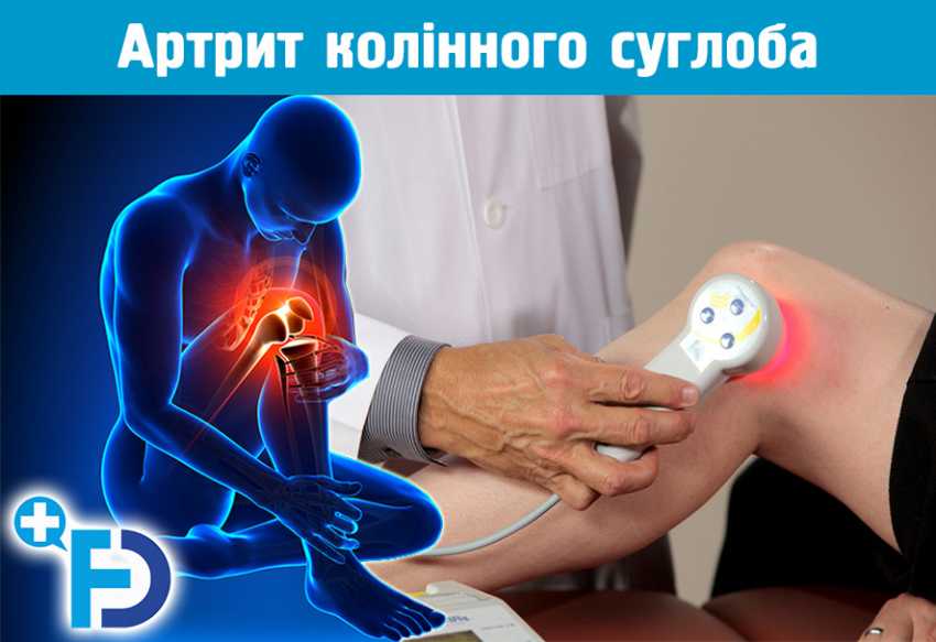 Артрит колінного суглоба: симптоми та лікування