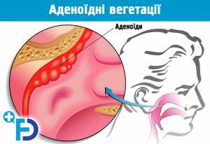 Аденоїди 1, 2 і 3 ступеня