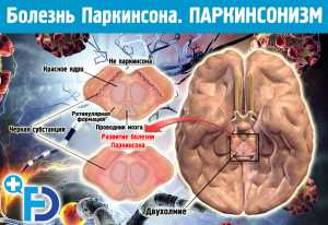 ПАРКИНСОНИЗМ. Болезнь Пакринсона: причины, симптомы и лечение