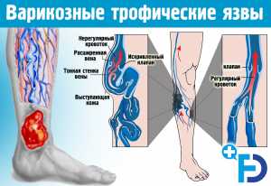 Варикозные трофические язвы