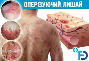 ОПЕРІЗУЮЧИЙ ЛИШАЙ (HERPES ZOSTER). Симптоми, шляхи передачі та лікування