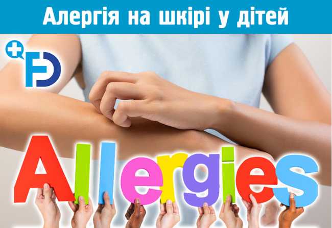 Алергія на шкірі у дітей. Діатез. Екзема. Дерматит