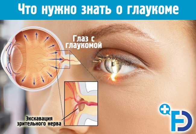 Глаукома. Что нужно знать о глаукоме