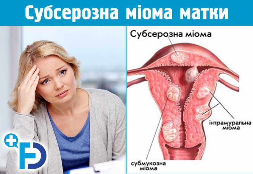 Субсерозна міома матки (субсерозний вузол): лікування