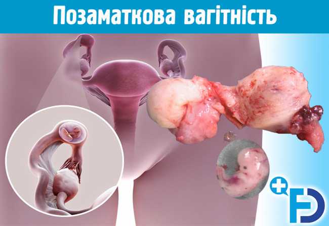 Позаматкова вагітність та пухирний занесок