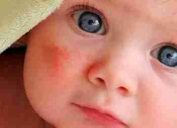 Діатез у немовлят: симптоми, ознаки, лікування