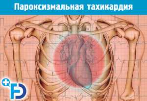 Пароксизмальная тахикардия (ПТ). Причины, симптомы, лечение